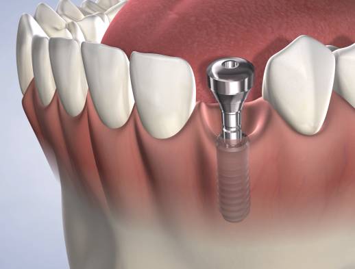 Learn about dental implants at Beech & Reid Oral & Dental Implant Surgery